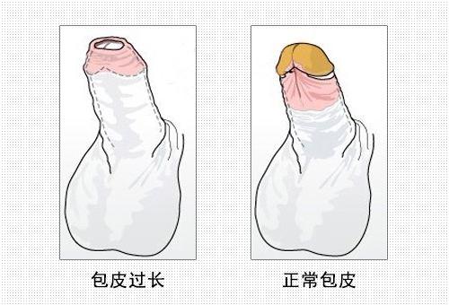 包皮不割有影響嗎？